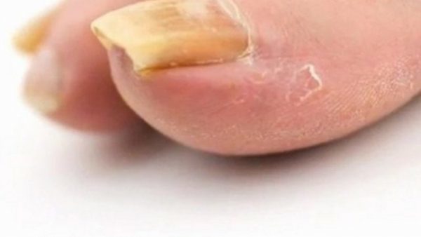 get rid of yellow nail