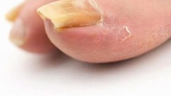 fix yellow nail