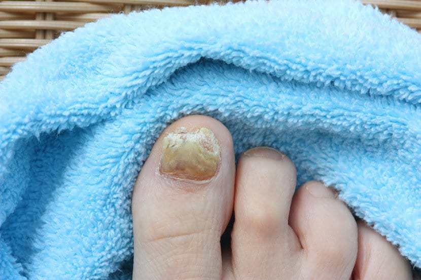 6 Most Effective Ways to Get Rid of Nail Fungus