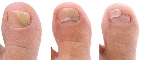 toe nail fungus