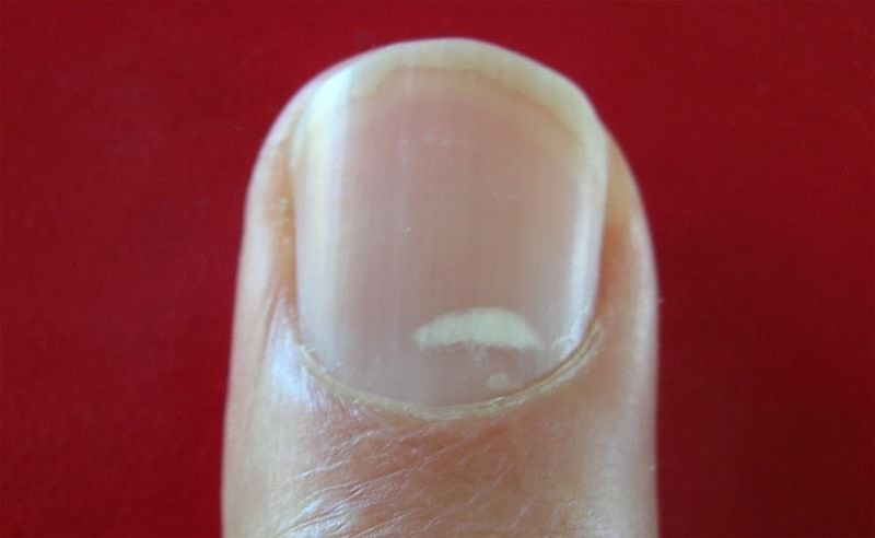 what-causes-persistent-white-spots-on-nails-naildesigncode