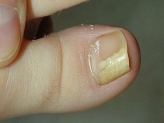 What Does Nail Fungus Look Like – NailDesignCode