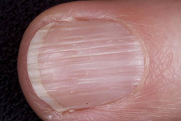 White Line On Fingernail Vertical