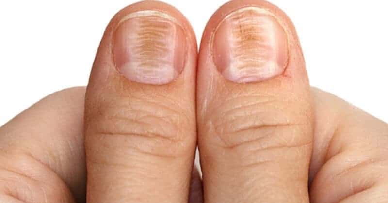 nail-ridges-causes-types-how-to-cure-naildesigncode