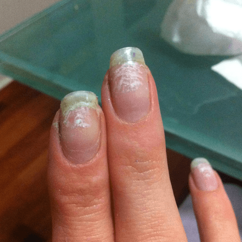 Example of White Nail Spots/Lines