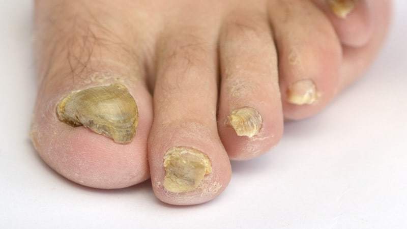 toenail fungus infection causes