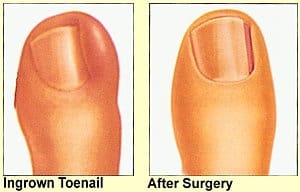 ingrown-toenails-care