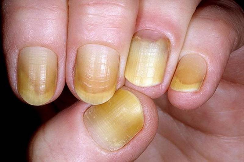 Why Do My Fingernails Turn Yellow