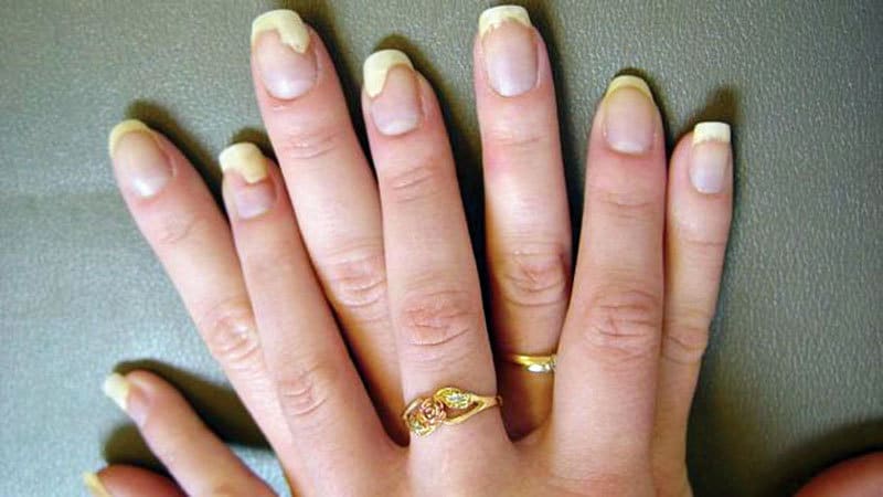 why-are-my-nails-yellow-the-actual-reason-revealed