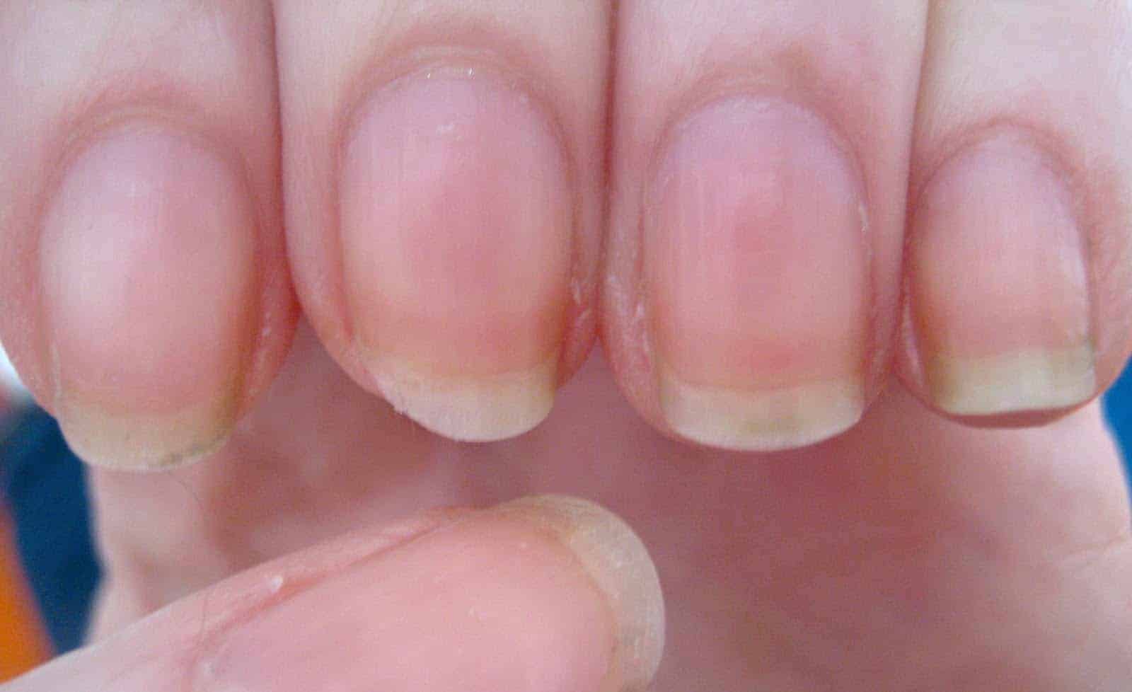 10 Most Common Nail Diseases And Disorders