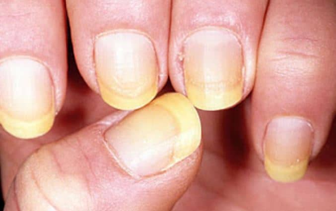 Yellow Nail Syndrome 