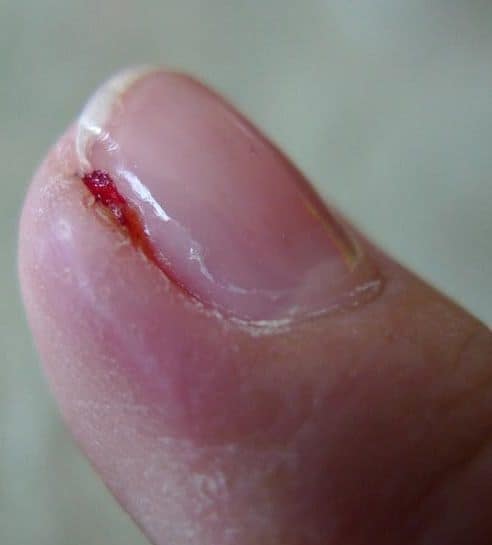 Acute infected cuticles