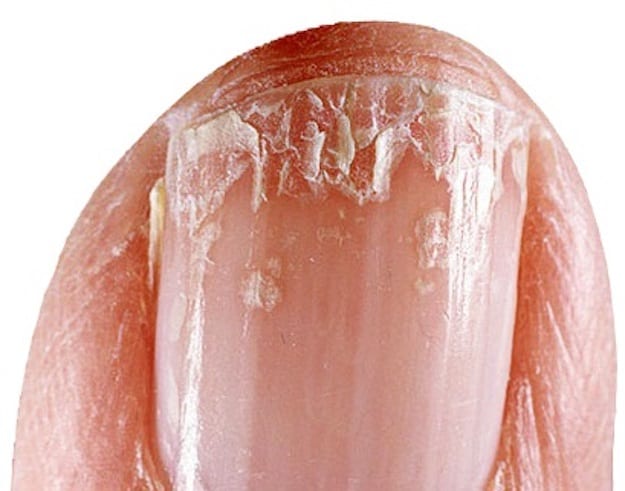 Split Fingernails Onychoschizia Symptoms Causes Remedies