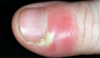 Chronic infected cuticles