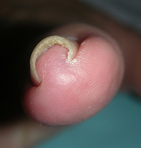 pincer nail photo