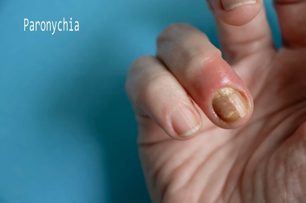 Signs of Infected Cuticle