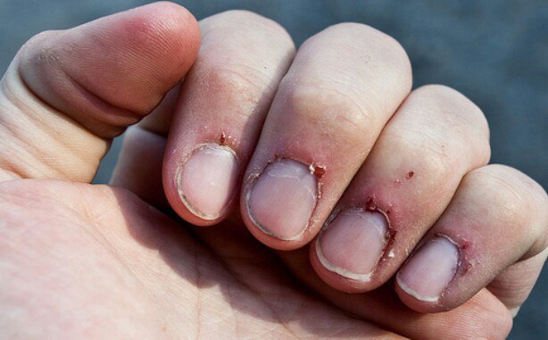 Infected Cuticles: Symptoms, Causes & Treatments