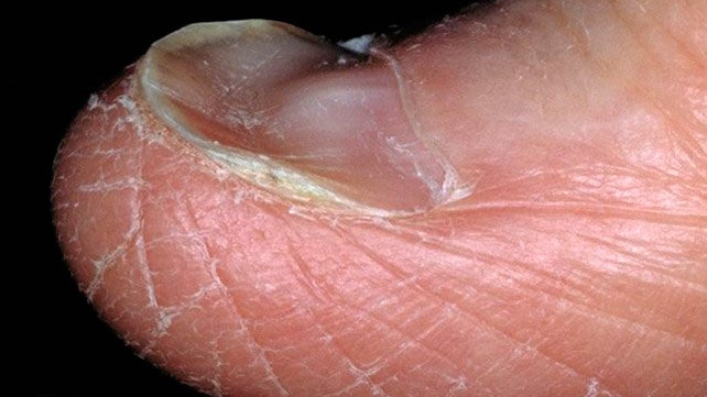 Spoon Nails (Koilonychia): Causes, Symptoms & Treatment