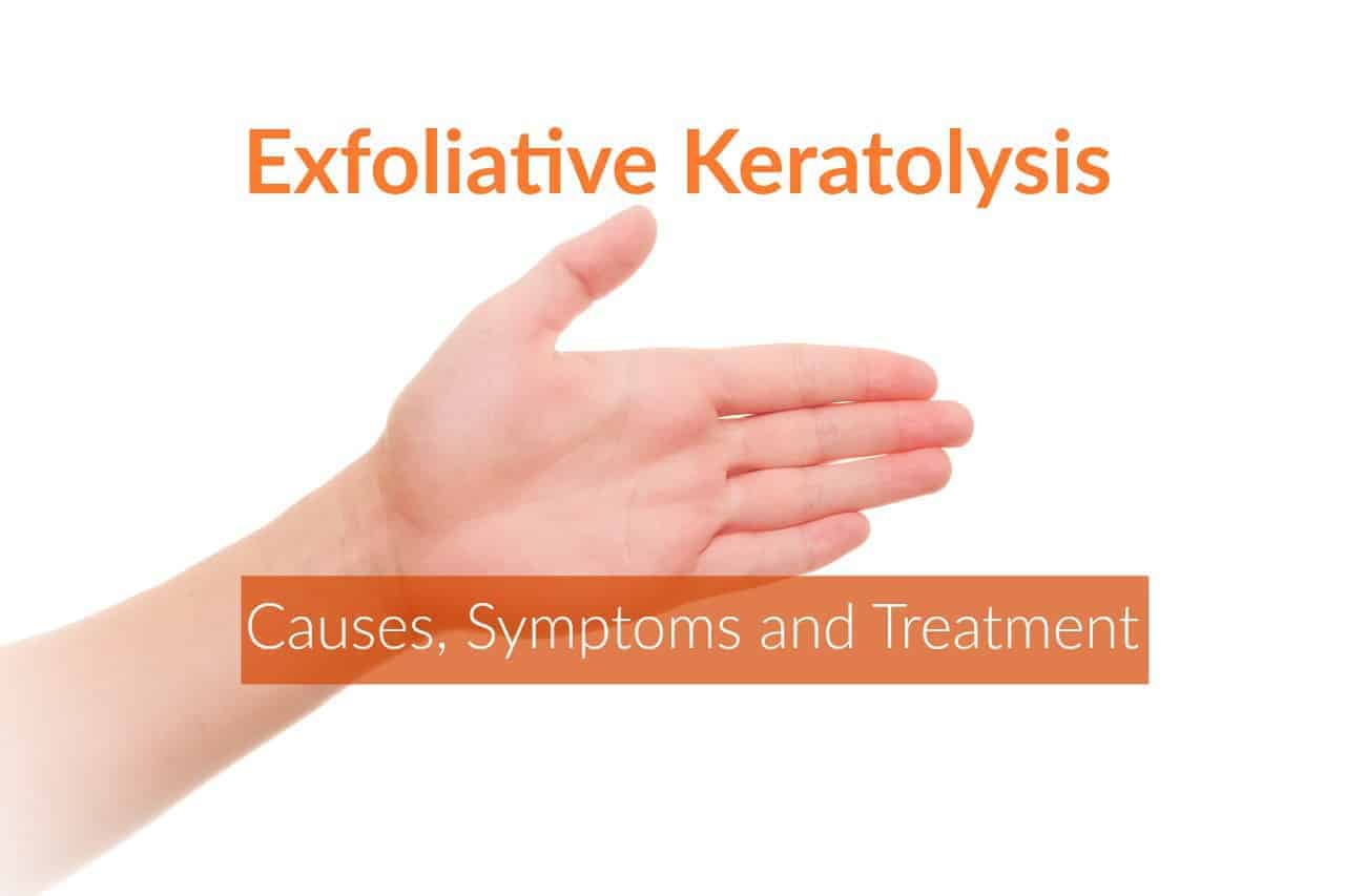 Exfoliative Keratolysis (Peeling Skin): Causes & Home Remedies
