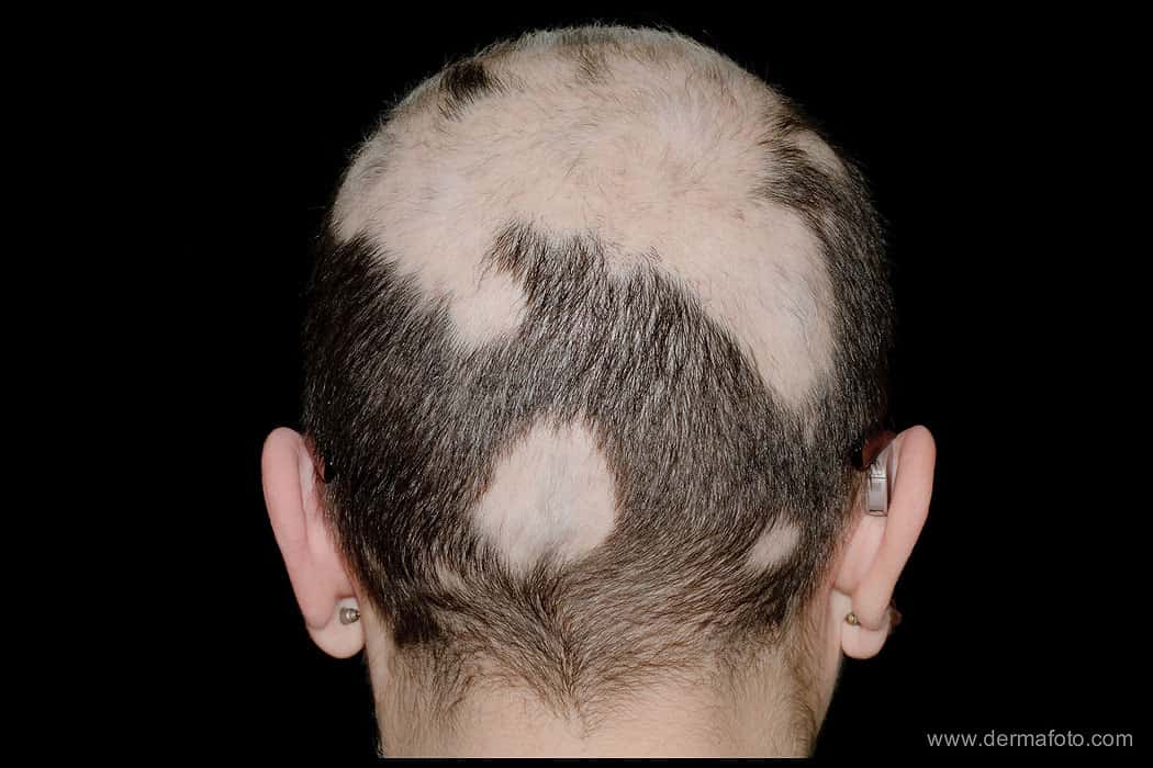 Причины выпадения волос у подростка. Очаговая (гнездная) алопеция. Очаговая алопеция лентовидная. Очаговая алопеция на голове. Гнездная алопеция офиазис.