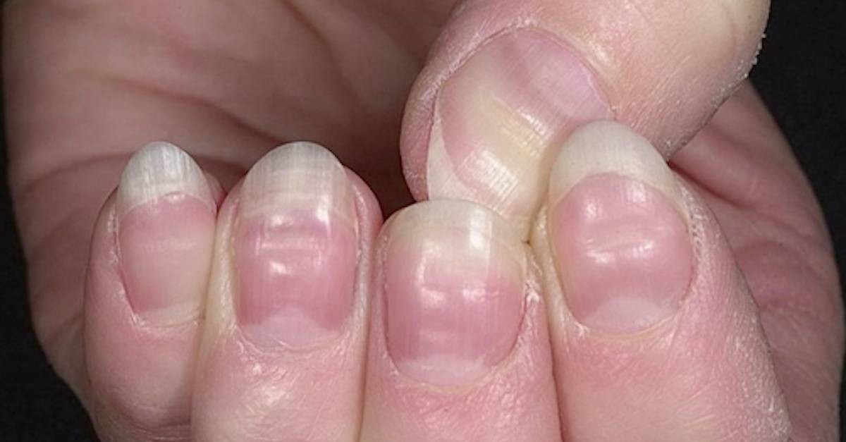 What Causes Deep Lines In Fingernails