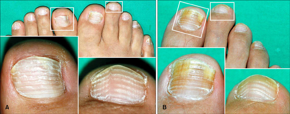 Beau's Lines Treatments