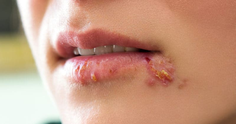 remove cold sores with nail polish remover