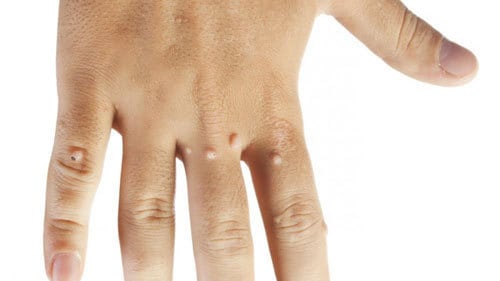 type of warts