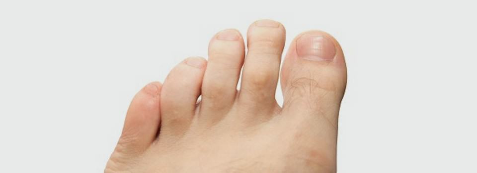 Symptoms of Hammer Toe