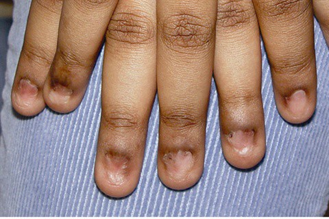 Pterygium Nail: Signs, Causes & Treatments – NailDesignCode