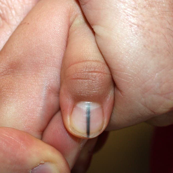 Longitudinal Melanonychia Normal Black Line On Nail Vs Melanoma