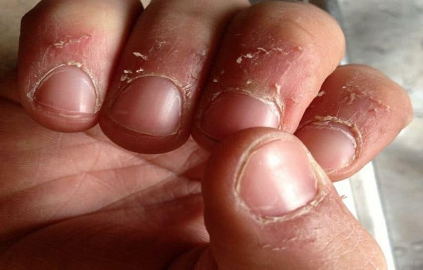 skin-peeling-on-fingers-near-nails-causes-and-remedies