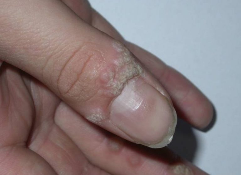 How to Get Rid of Warts 2 Best Home Remedies NailDesignCode