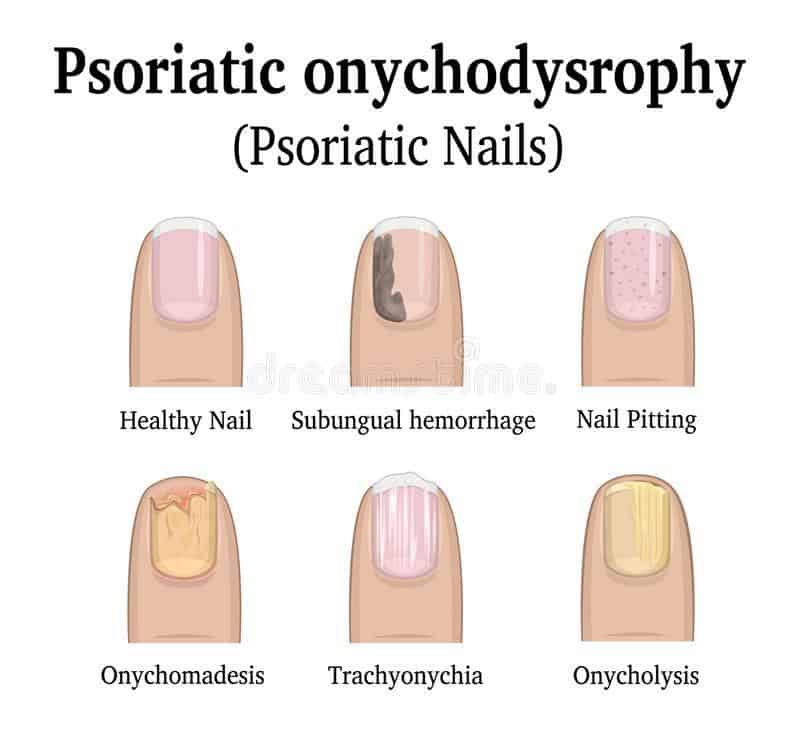 Psoriasis of the Fingernails