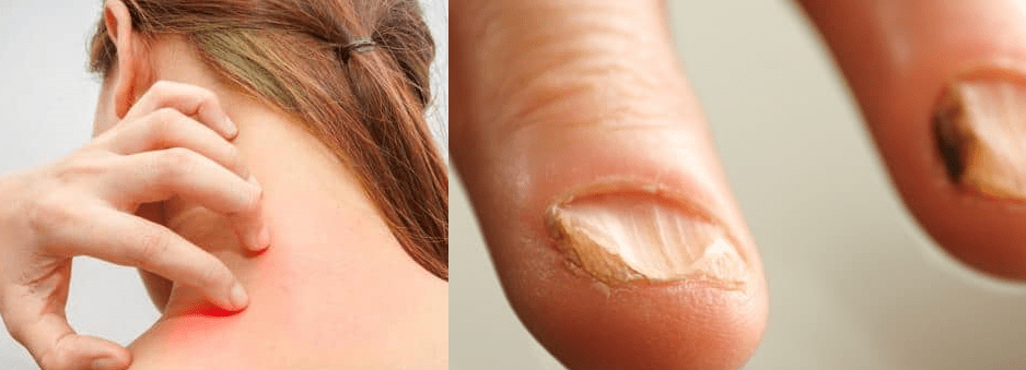 Symptoms of Candidiasis of Skin & Nails