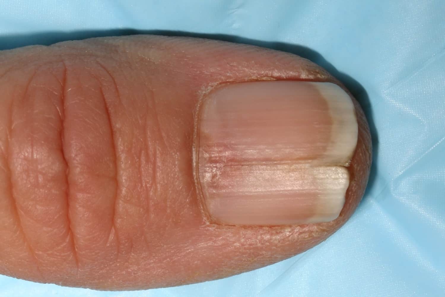 Split Nail