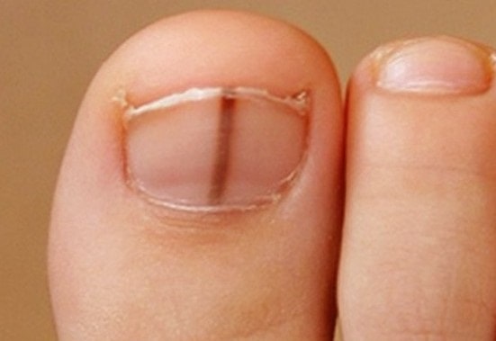 Horizontal Red Line Under Big Toenail