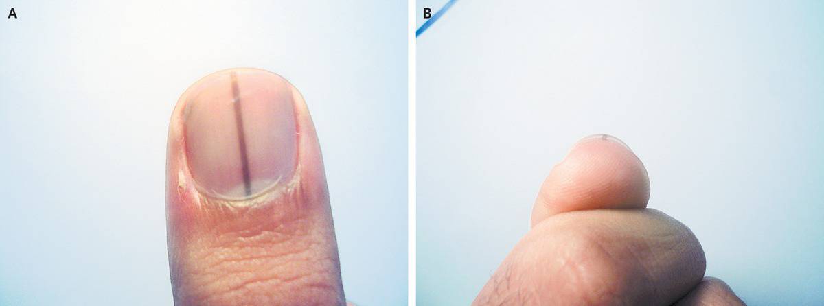 Symptoms of Subungual Melanoma