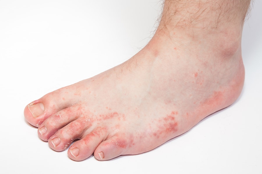 Causes of Athlete's Foot