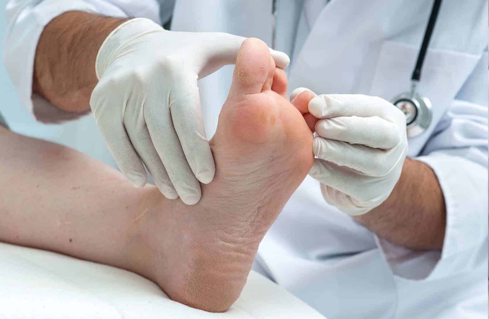 Athlete's Foot Facts The Causes, Diagnosis & Treatment Options