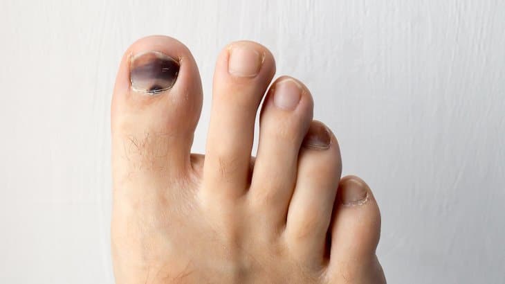 toenail turning black