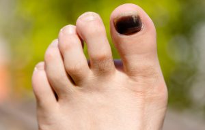 Dark Spots on Toenails: Is it Bruising, Fungus, or Melody?