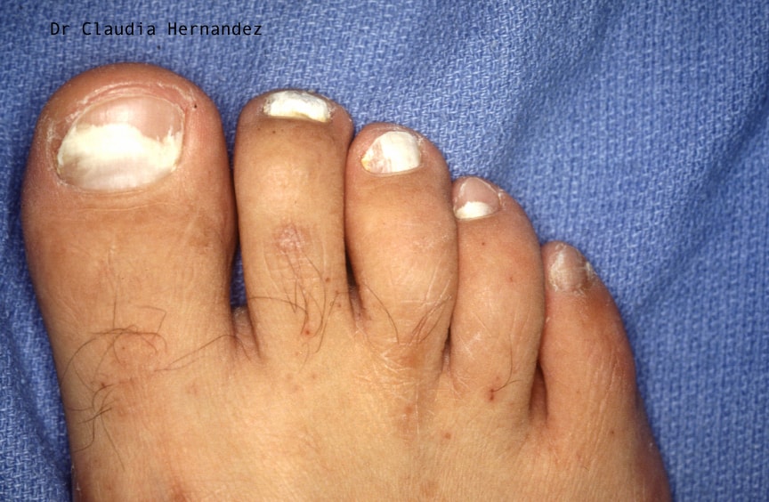 Types of on sale toenail fungus