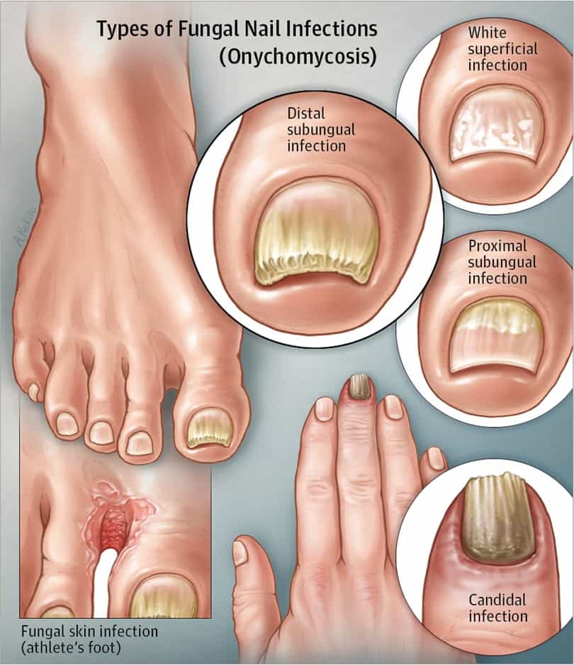 types of White Superficial Onychomycosis