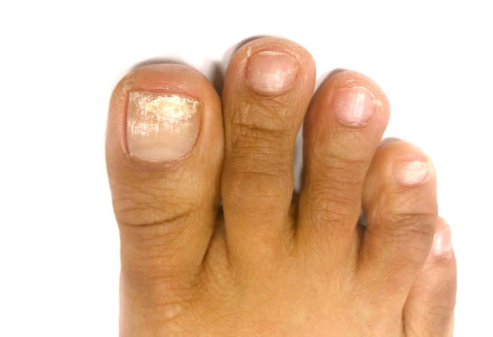 White Superficial Onychomycosis