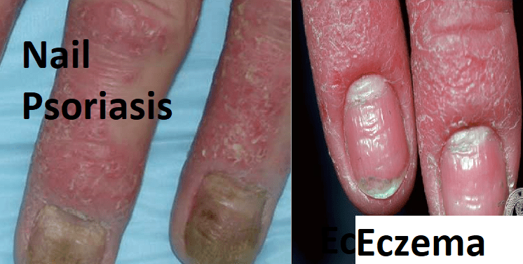 difference between Nail Psoriasis & eczema