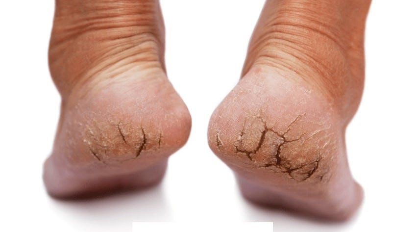 What Causes Severe Dry Skin On Feet