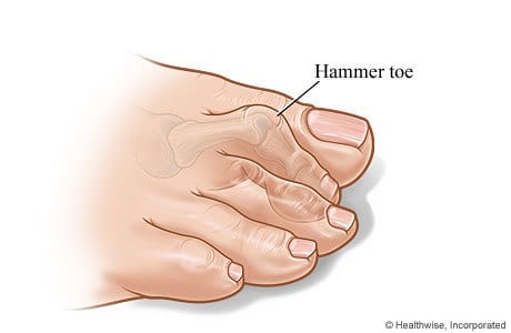 what is hammer toe