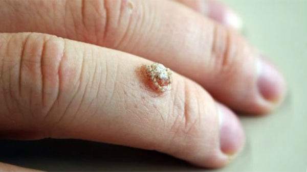How to Get Rid of Warts: 2 Best Home Remedies
