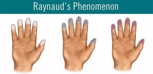 Raynaud’s Syndrome: What Is It & When to See A Doc?
